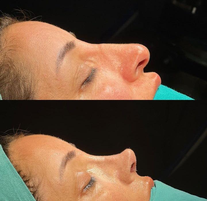 Rhinoplasty