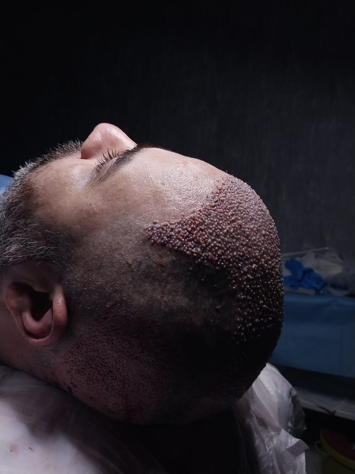 Hair Transplant