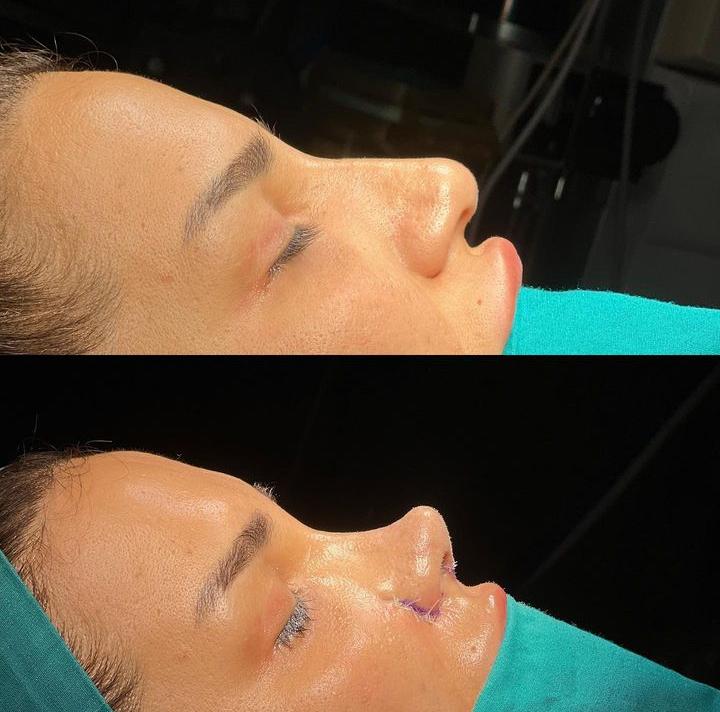 Rhinoplasty