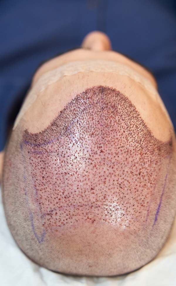 Hair Transplant