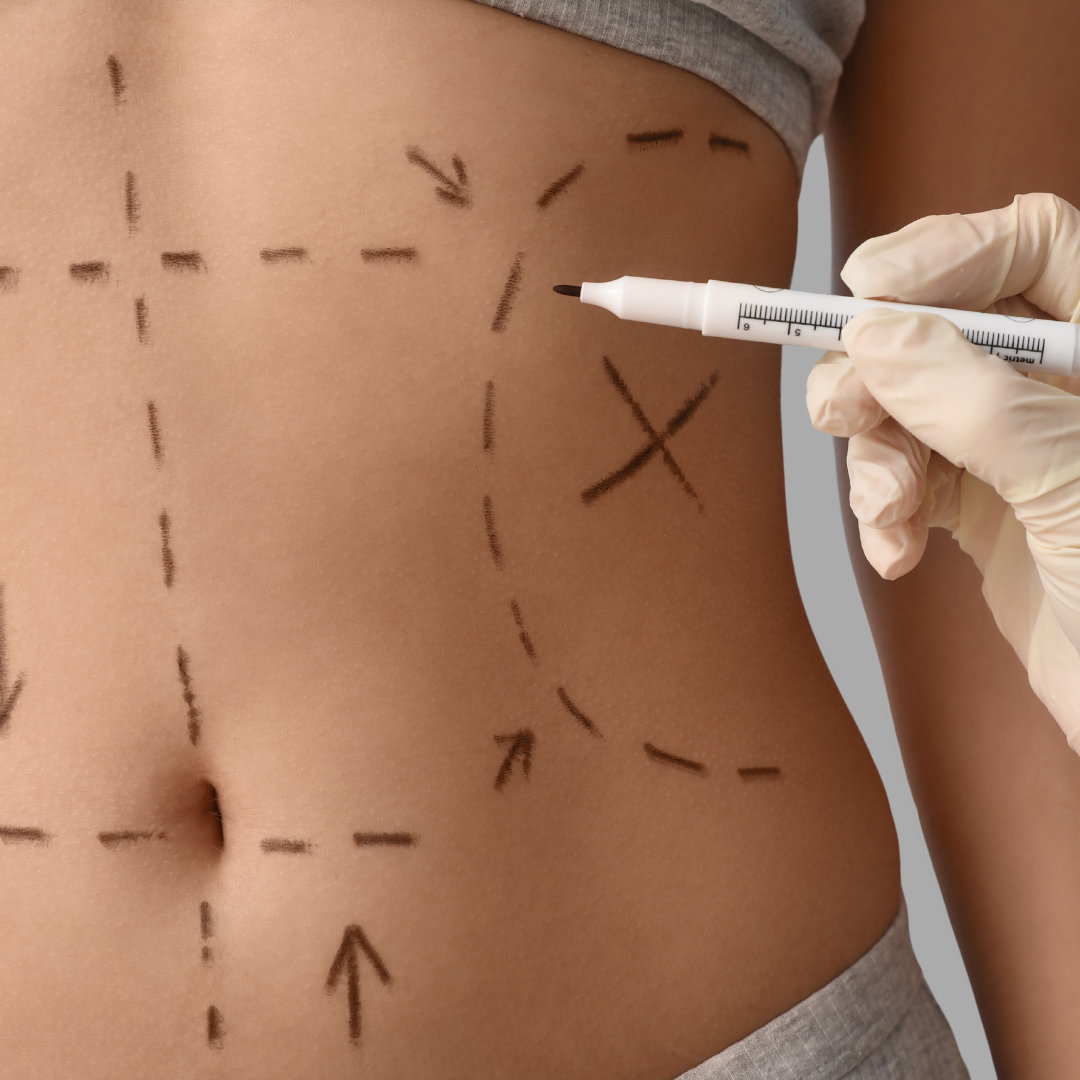 Liposuction