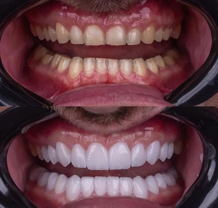 Hollywood smile