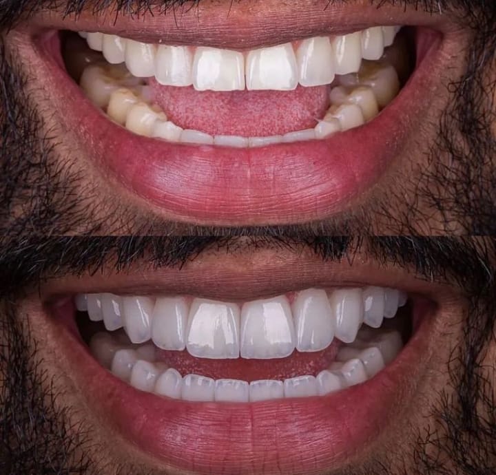 Hollywood smile