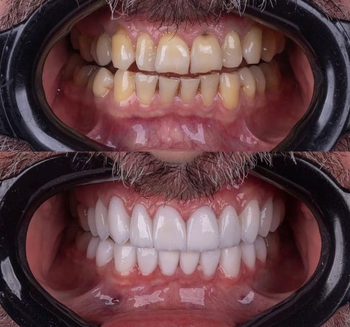 Hollywood smile