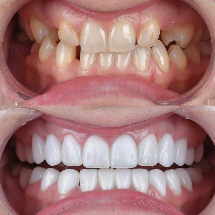 Veneer
