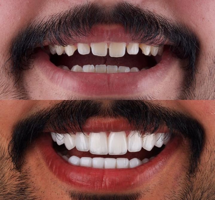 Veneer