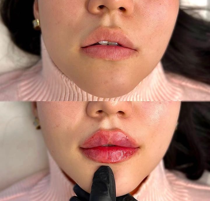 Dermal Fillers