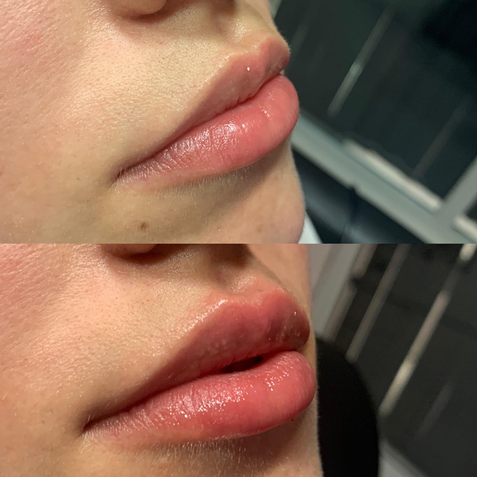 Dermal Fillers