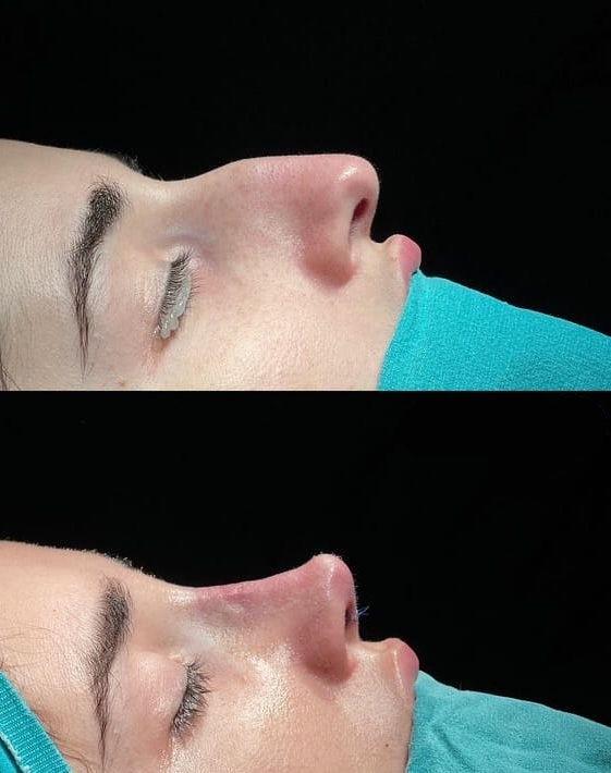 Rhinoplasty