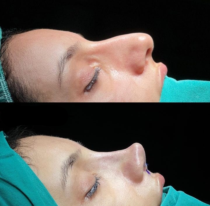 Rhinoplasty